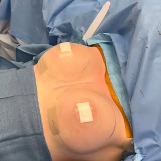 Natural-looking is always the goal. 🤍🍒

A breast augmentation doesn’t have to mean an obvious or o