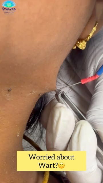 Wart removal call:72002 00751 @smaavins #chennai #vadapalani #trending #viralreels #skintreatments