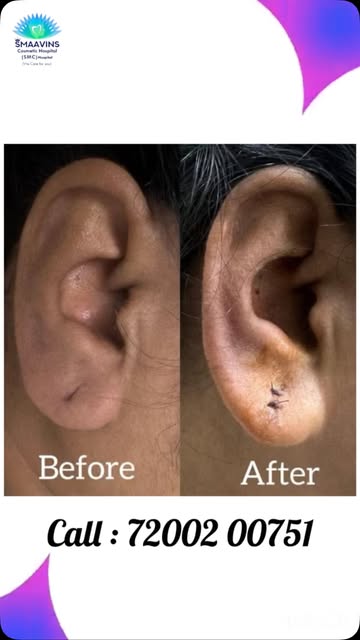EAR LOBE call:72002 00751 @smaavins #chennai #vadapalani #trending #viralreels #earlobe