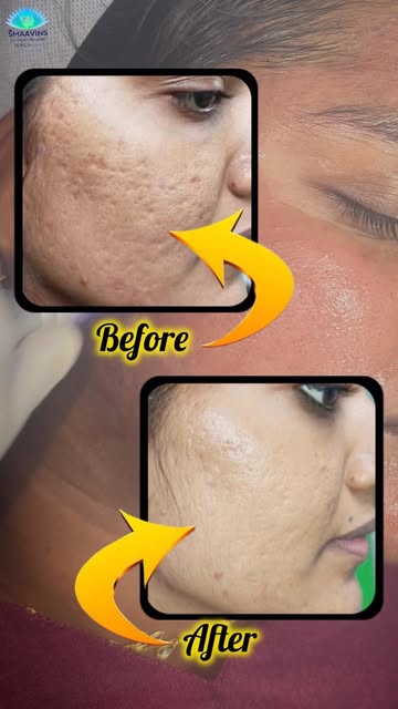 Face PRP & MNRF treatment call:72002 00751 @smaavins #chennai #vadapalani #trending #viralreels #ski