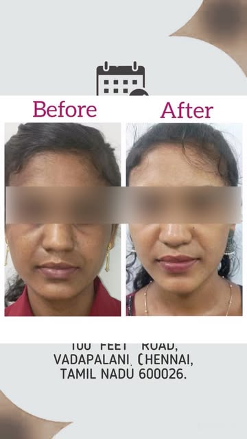 Skin whitening @smaavins #chennai #vadapalani #glowingskin #skinwhitening
