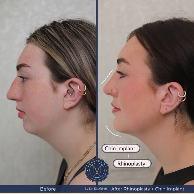 Rhinoplasty + Chin Implant, a match made in heaven for achieving facial harmony. 

This lovely patie
