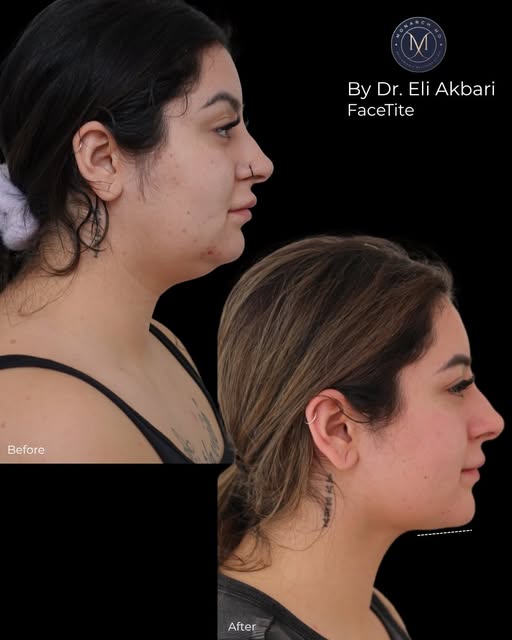 FaceTite! 

Designed for those starting to notice laxity, softening along the jawline, or under the 