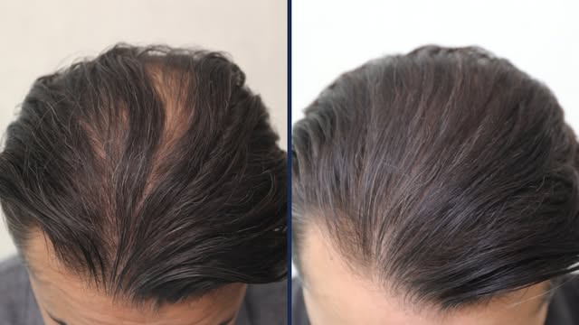 Swipe to see the difference close up under a trichoscope. If he hadn't come in, those hairs would ha