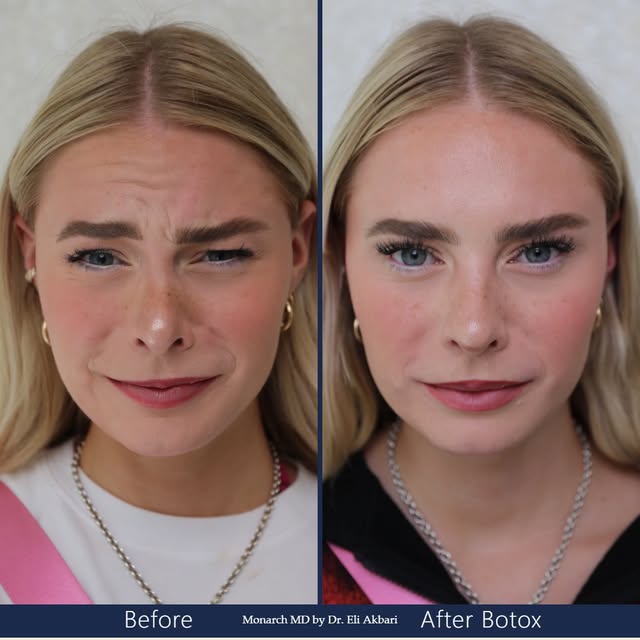 Beautiful before, and beautiful after. The purpose of Botox here is to help prevent the formation of
