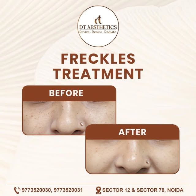 📩DM for special offer 🎉 
FRECKLES TREATMENT — HEALTHIER, MORE EVEN-LOOKING SKIN ✨

Freckles can be
