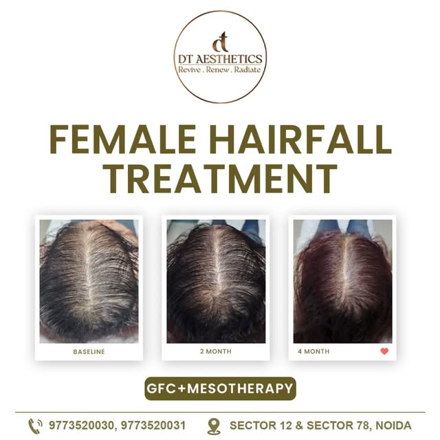 Hair fall can be managed. Healthy hair can be restored. ✨

A visible transformation over 4 months wi