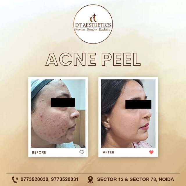 Acne, active breakouts, clogged pores and post-acne marks can affect more than just your skin. An Ac