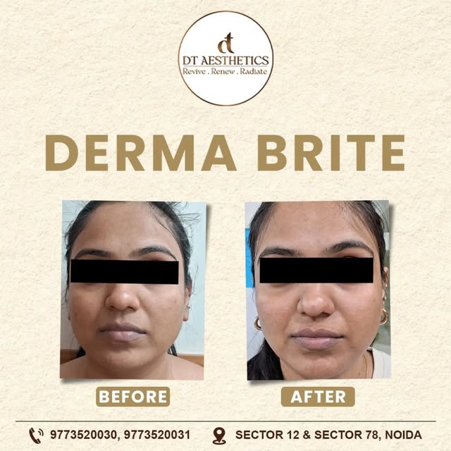 📩DM for special offer 🎉 DERMA BRITE — Reveal Your Skin’s Natural Radiance! ✨

A visible transforma