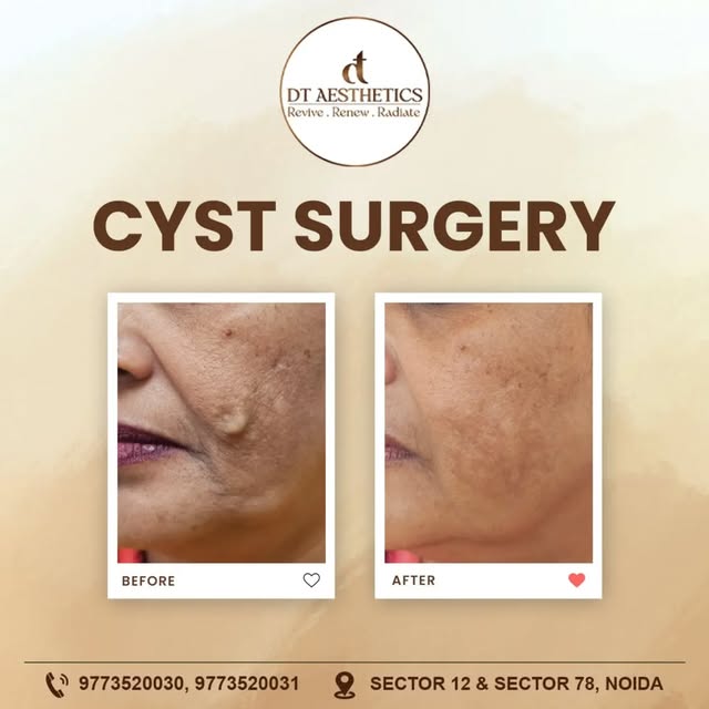 📩 DM for special offer 🎉 Cyst Surgery – Before & After ✨

A visible difference can make a meaningf