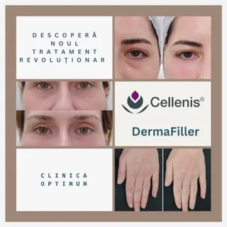 ❗🧪Descoperă acum tratamentul revoluționar cu Cellenis Dermafiller!
⁉️Cellenis Dermafiller este un p
