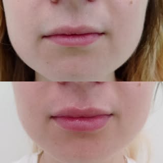 Prin injectarea de acid hialuronic putem corecta micile asimetrii și să aducem un plus de hidratare,