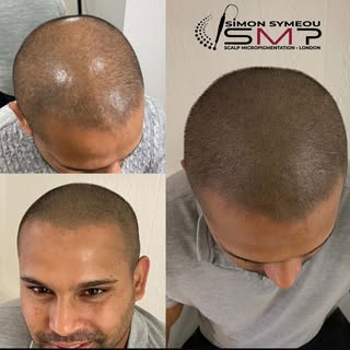 Natural looking density procedure #smp #scalpmicropigmentation #scalptattoo #density #hairtransforma