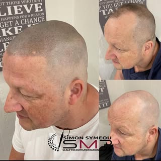 SMP is a no brainier for those who want to be there best version #smp #scalpmicropigmentation #skalp