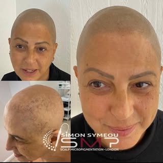25 years suffering from Alopecia, not anymore #smp #scalpmicropigmentation #scalp #alopecia #hairtat