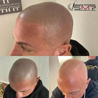 🧑‍🎨#smp #scalpmicropigmentation #scalptattoo #hairtattoo #smplondon #scalpsmp #pmu #confidence #ba