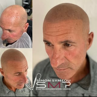 Who needs hair when you can look better without it..#smp #sᴄᴀʟᴘᴍɪᴄʀᴏᴘɪɢᴍᴇɴᴛᴀᴛɪᴏɴ #scalptattooing #sc