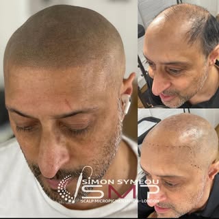 From a Hair transplant to a Hair system and now a no brainier SMP  #smp #scalpmicropigmentation #sca