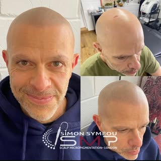 👌#smp #scalptattoo #scalpmicropigmentation #headtsttoo #skalp