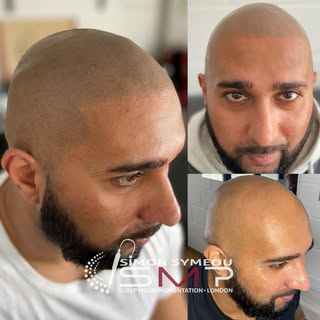 Alopecia is not a problem,here’s the solution #smp #scalpmicropigmentation #scalptattoo #headtattoo 