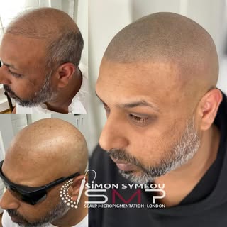 Another hair transplant not very successful respect to SMP #scalpmicropigmentation #scalptattoo #hai