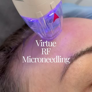 Discover Virtue RF Microneedling at our clinic!

Improve skin tone, tighten skin, and reduce fine li