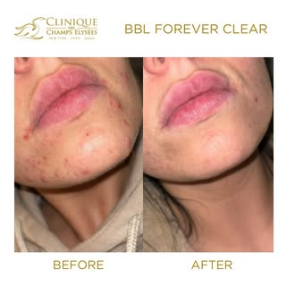 BBL Results by @colettebycolette 
Redness & Acne Marks Faded 

Tatiana came to us looking to reduce 