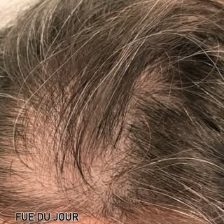 Séance de greffe cheveux en technique FUE pour corriger une alopécie androgenetique de la région fro