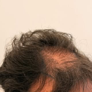 Séance de greffe de cheveux en technique FUE sans rasage pour une alopécie androgenetique chez un pa
