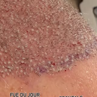 Séance de greffe de cheveux en technique FUE, 1500 implants #greffefue #greffedecheveux #implantsfue