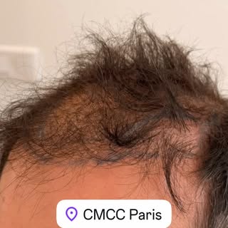 Évolution d’une greffe de cheveux en technique FUE à 15 jours.
#greffefue #greffecheveux #implantsfu
