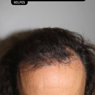 Résultat à 7 mois d’une greffe de cheveux en technique FUE pour corriger une alopécie androgenetique