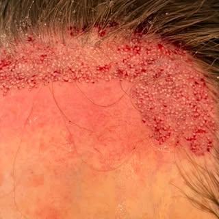 Greffe de cheveux et alopécie frontale fibrosante : est-ce possible ? 🤔

Oui, une greffe de cheveux