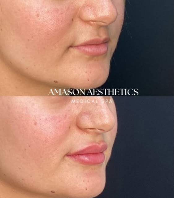 A little lip refresh 

Before ➡️ After

She wanted a little more shape and fullness, but still wante
