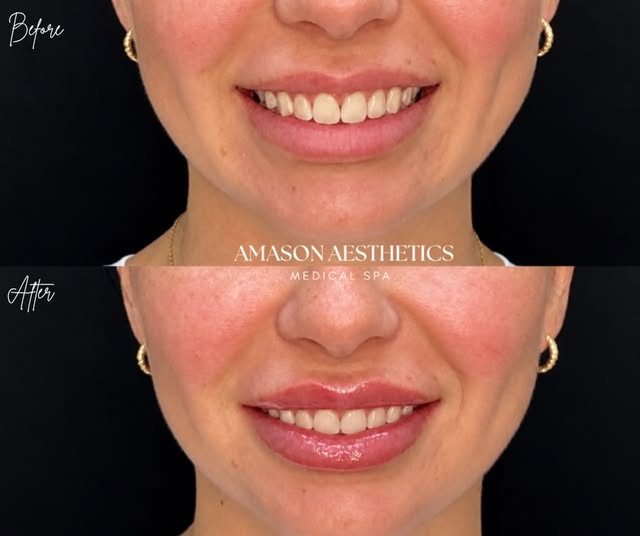 Before & immediately after lip filler 💋 The goal was to enhance this patient’s beautiful natural li
