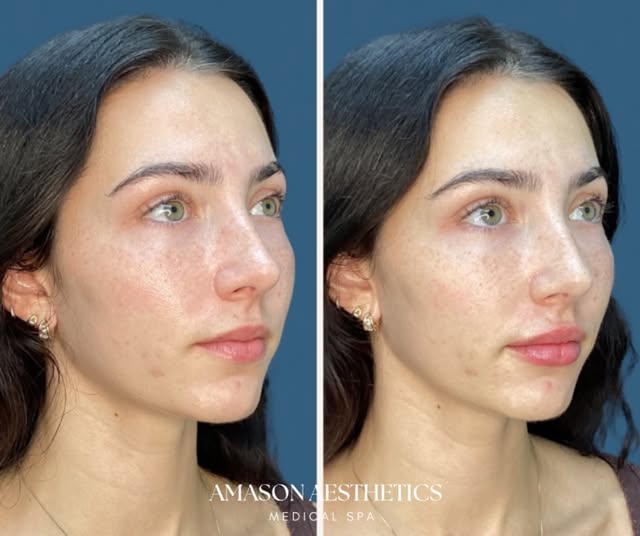 ✨Undetectable lip filler is one of my favorite treatments to perform.

I love using soft hyaluronic 