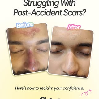 Accidents and injuries can leave behind scars with uneven texture, dents, and rough patches — but th