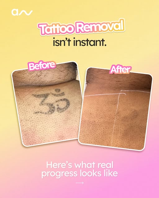 Tattoo removal is a process — and that’s exactly how it should be.

Laser tattoo removal works gradu