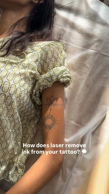 Tattoo removal is basically a lot of precision + a little patience. This was session 2 and while the