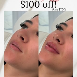 Holiday Lip Promo💋
🎁Get $100 off lip filler through the month of December 
Normally $700 NOW just 