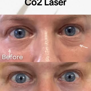 ⚡️Co2 Laser Eyelids Rejuvenation Promo (limited time offer) ~ the BEST non-surgical option for eyeli