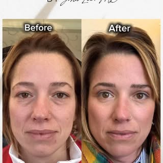 “Less is more” is Dr. Lee’s philosophy. Beautiful results achieved with only:

✅ Upper lids bleph w/