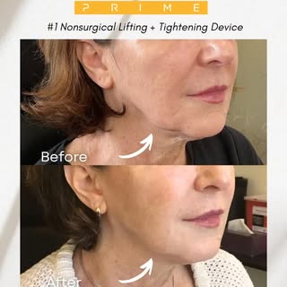 🥇#1 FDA-approved for non-surgical lifting & tightening - @ultherapy PRIME!

The newest device Ulthe