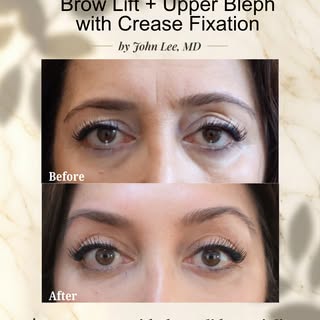 Performed to achieve results:
✅ Dr. Lee’s signature in-office brow lift
✅ Upper blepharoplasty w/ cr