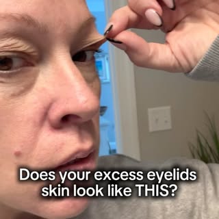 ✨ Are you tired of looking tired? 
A one-hour office blepharoplasty surgery can resolve this! 

She 