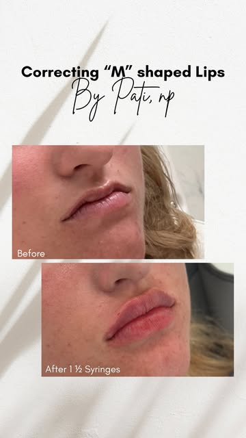 “M” shaped lips require a different approach 👄

Rather than simply adding volume, the goal is to ca