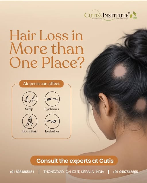 Hair Loss in More Than One Area? Make Sure It’s Not Alopecia.

Normal hair fall usually happens from