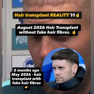 Another one ☝️ (Not here to mock Fabian or people using hair fibres, just show you the reality of a 
