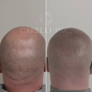 Scalp Micropigmentation SMP with Ant @ Capelli

Stop wasting your time with useless, fake, temporary