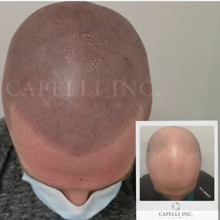 Scalp Micropigmentation SMP

Capelli Inc

No.1 Clinic

World Renowned. 

Don’t miss out. 

DM to enq